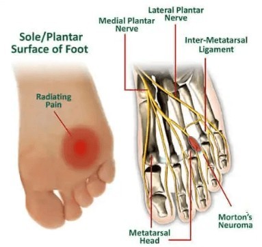 Foot diagram indicating inflammation at the ball of foot affected by Morton's Neuroma