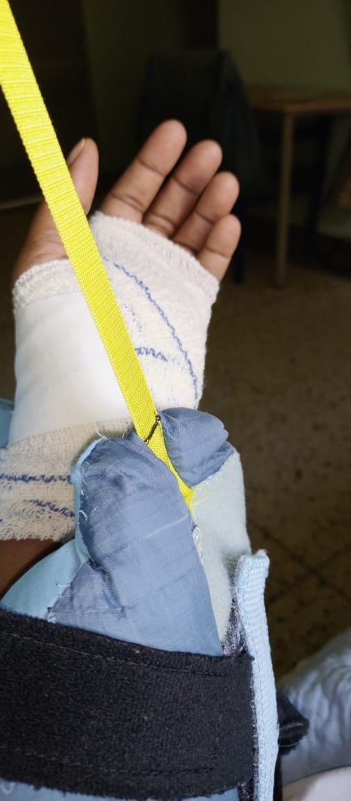 Left hand and wrist in a brace with sling during carpal tunnel recovery