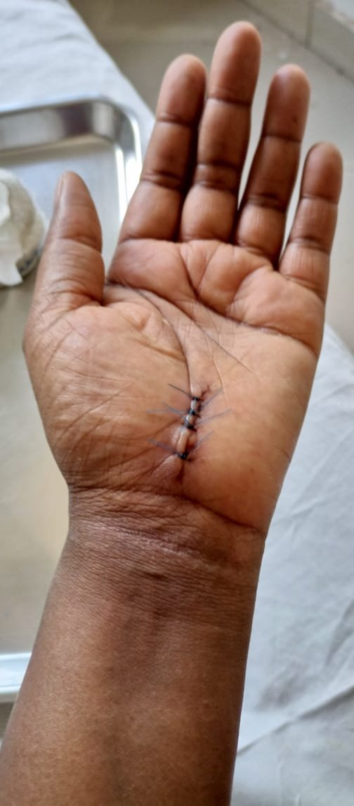 Fresh stitches on palm after left hand carpal tunnel release surgery